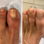 “Já tinha tentado pomadas, sprays e até cápsulas, mas nada resolvia. Depois de começar o uso do Dermavitale, em poucas semanas o aspecto da minha unha mudou completamente. Estou muito satisfeito — e aliviado por finalmente ver resultado!” Carlos Benedito ✓