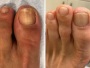 “Já tinha tentado pomadas, sprays e até cápsulas, mas nada resolvia. Depois de começar o uso do Dermavitale, em poucas semanas o aspecto da minha unha mudou completamente. Estou muito satisfeito — e aliviado por finalmente ver resultado!” Carlos Benedito ✓